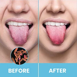 Tongue Scraper For Adults By Hokin (2Pcs Oral Care Pack) Stainless Steel Tongue Cleaners Reduce Bad Breath 100% Metal Tough Scrapers Men And Women Hy