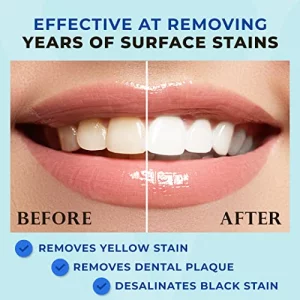 Venus Visage Award Winning Teeth Whitening Pen (2 Pens), 20+ Uses - Teeth Whitening Gel Professionally Formulated - Best Teeth Whitening Kit Teeth Wh